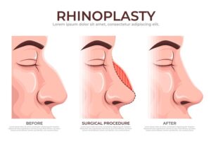 متى ترجع حاسة الشم بعد عملية تجميل الانف